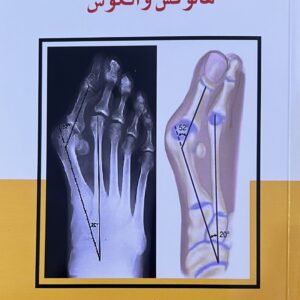 کتاب تکنیک های جراحی هالوکس والکوس ترجمه امیر جعفر ادیبی